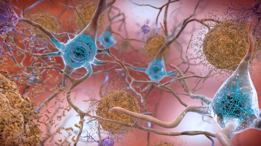 Illustration of neurons in the brain with amyloid-beta plaques and tau tangles characteristic of Alzheimer's disease