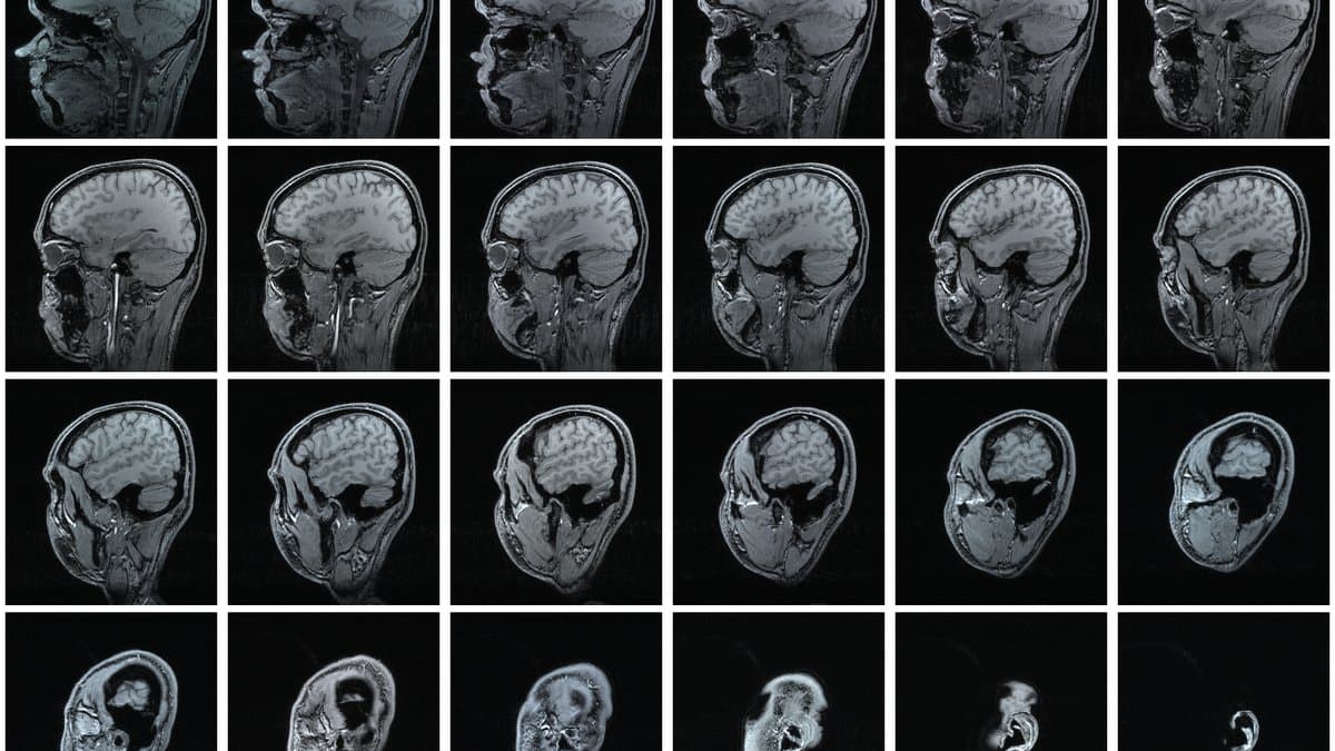 A grid of sagittal magnetic resonance imaging slices through a single human head, showing the brain in greyscale cross-section.