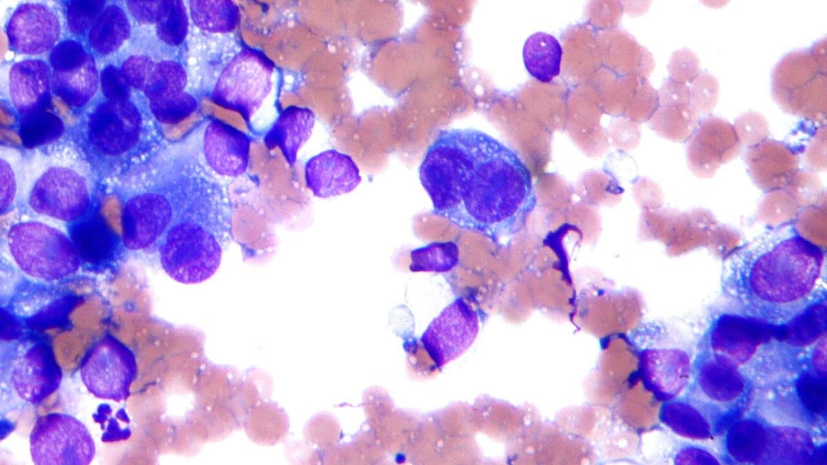 Micrograph of a cytology smear showing melanoma cells with dark pigment granules, field stain