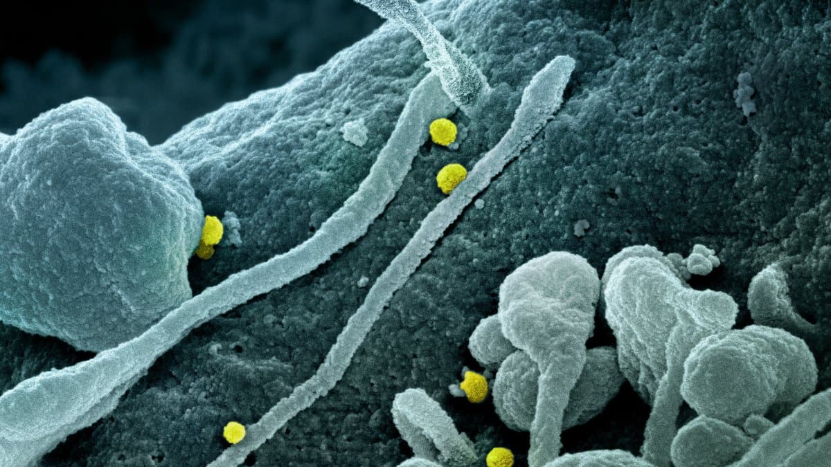Colorized electron micrograph showing small round Crimean-Congo haemorrhagic fever virus particles, tinted yellow, on the textured surface of an infected cell