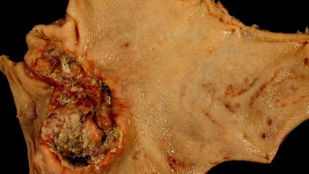 A resected stomach specimen showing a gastric adenocarcinoma against the surrounding gastric lining.