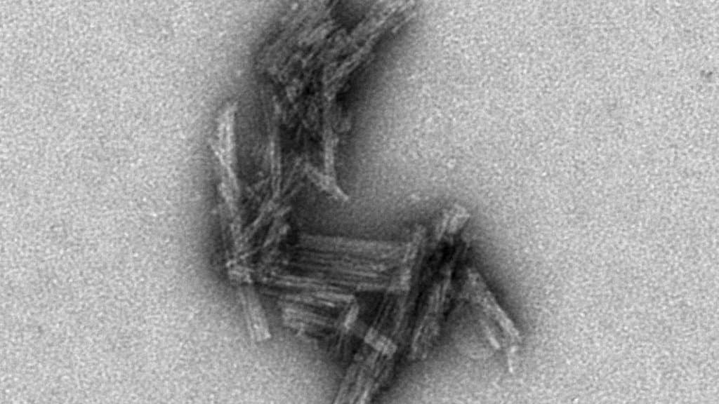 Electron micrograph showing a dense cluster of tau filaments.