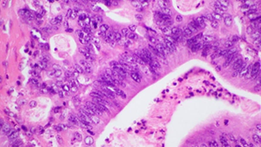 Micrograph of pancreatic ductal adenocarcinoma stained with haematoxylin and eosin, showing irregular malignant glands with darkly stained nuclei.