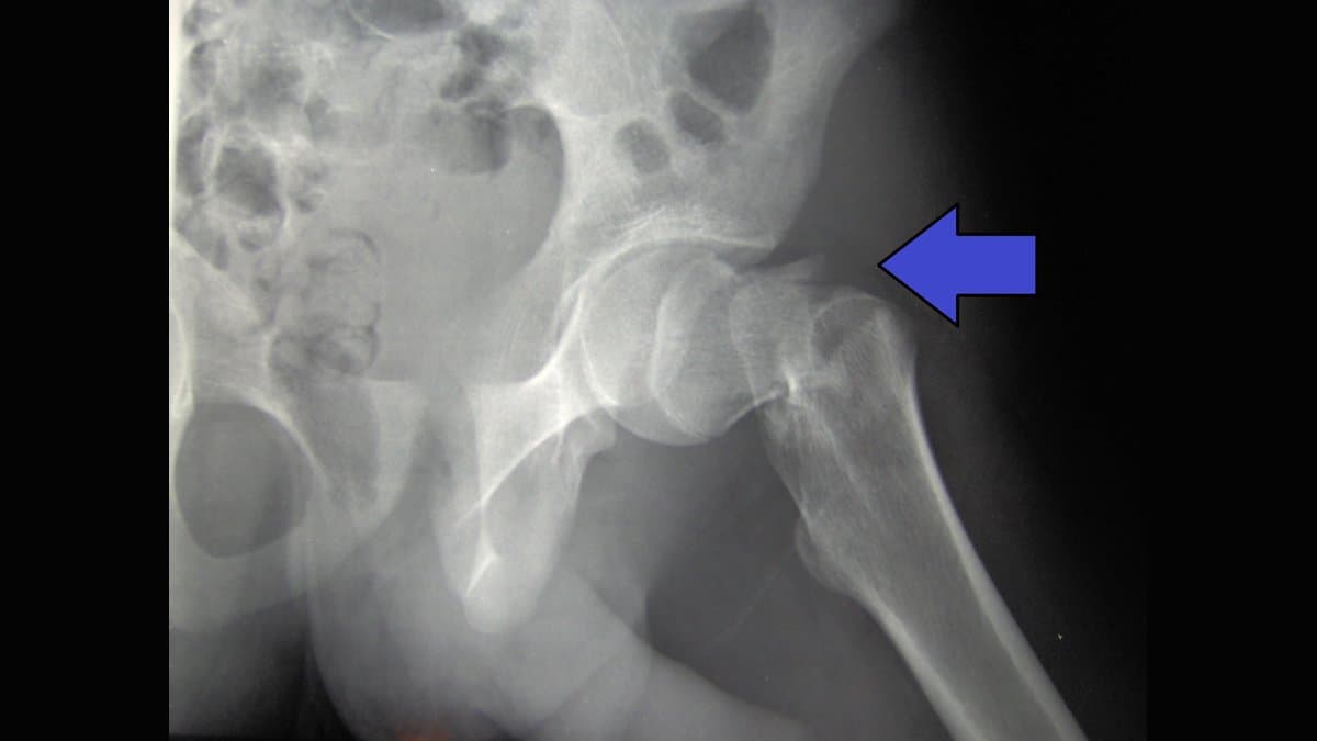 A plain X-ray of a hip, with a blue arrow marking the fracture line across the top of the thigh bone