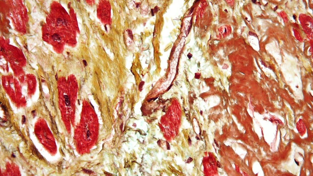 Photomicrograph of heart muscle in cardiac amyloidosis: bright red muscle fibres are pushed apart by broad olive-yellow deposits of amyloid.