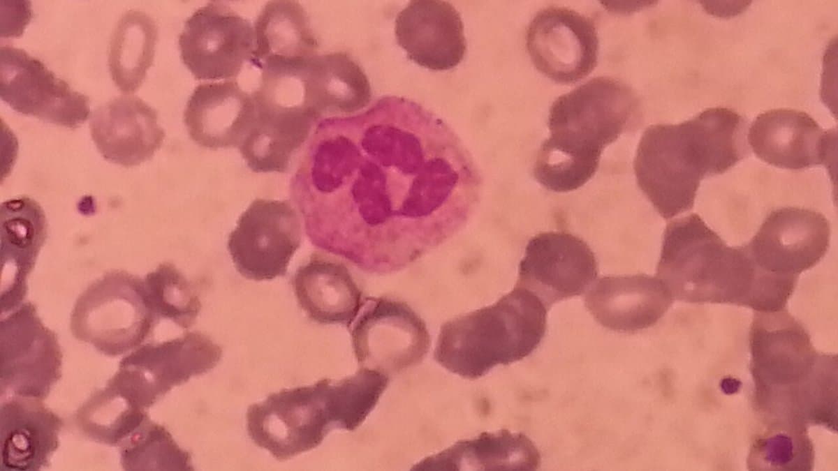 A Wright's-stained peripheral blood smear seen under a microscope: dozens of pale pink red blood cells fill the frame around a single white blood cell with a deep purple lobed nucleus.