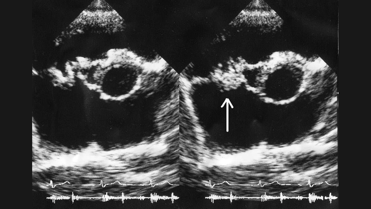 Two side-by-side greyscale echocardiogram frames of a heart, with an arrow in the right-hand frame pointing to an abnormal mass on a valve, and ECG traces running along the bottom of each frame.