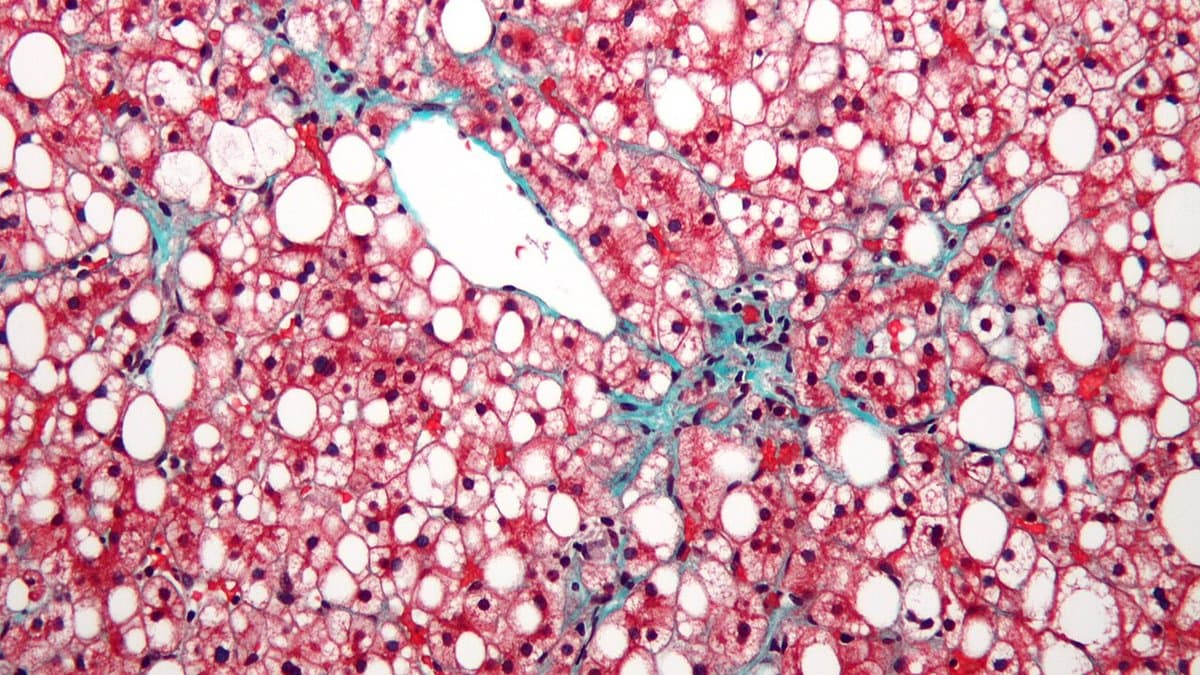 Photomicrograph of liver tissue in fatty liver disease: red-pink liver cells are crowded with round white fat droplets, with thin blue-green strands of connective tissue between them.
