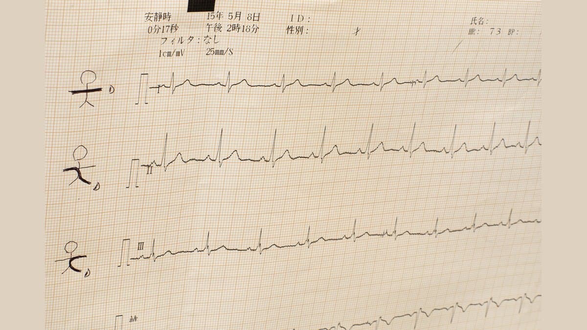 A close-up photograph of a paper electrocardiogram printout, showing several rows of heartbeat traces inked on graph paper above a printed header of recording settings.