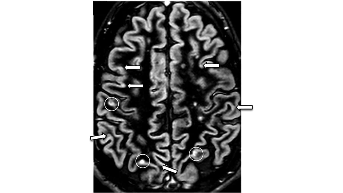 Axial magnetic resonance image of a human brain, with white arrows and circles marking multiple sclerosis lesions in the cortex and adjacent white matter.