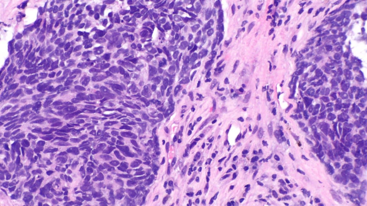 Photomicrograph of a haematoxylin and eosin stained tissue section showing dense purple nests of non-small cell lung carcinoma cells separated by strands of pink stroma.