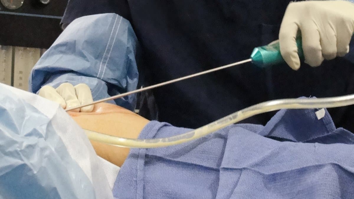 A gloved surgeon guides a liposuction cannula through a small incision in a patient's draped skin during surgery, with suction tubing running across the frame.