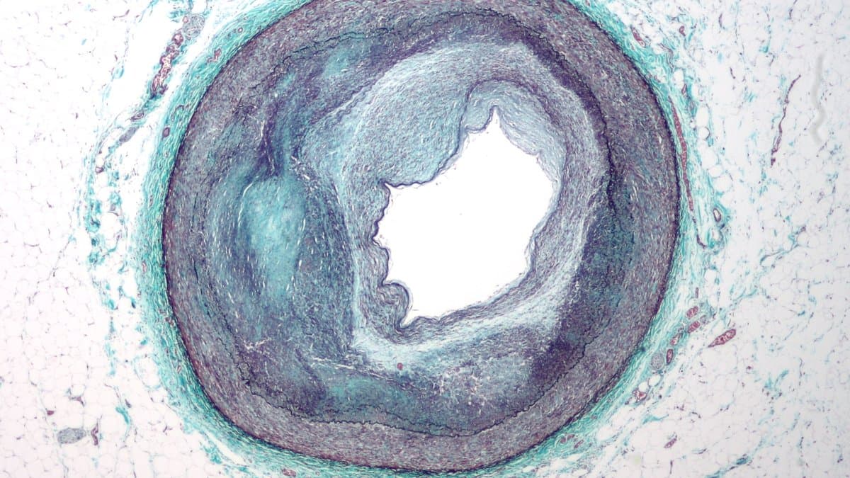 Stained microscope cross-section of a human coronary artery whose channel has been narrowed to a small irregular opening by a thick surrounding ring of atherosclerotic plaque.