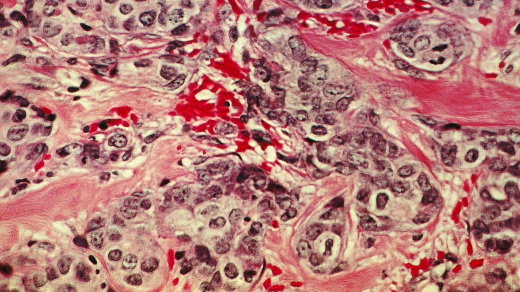 Light micrograph of breast cancer tissue, showing clusters of dark-stained carcinoma cells surrounded by pink connective tissue and red blood.