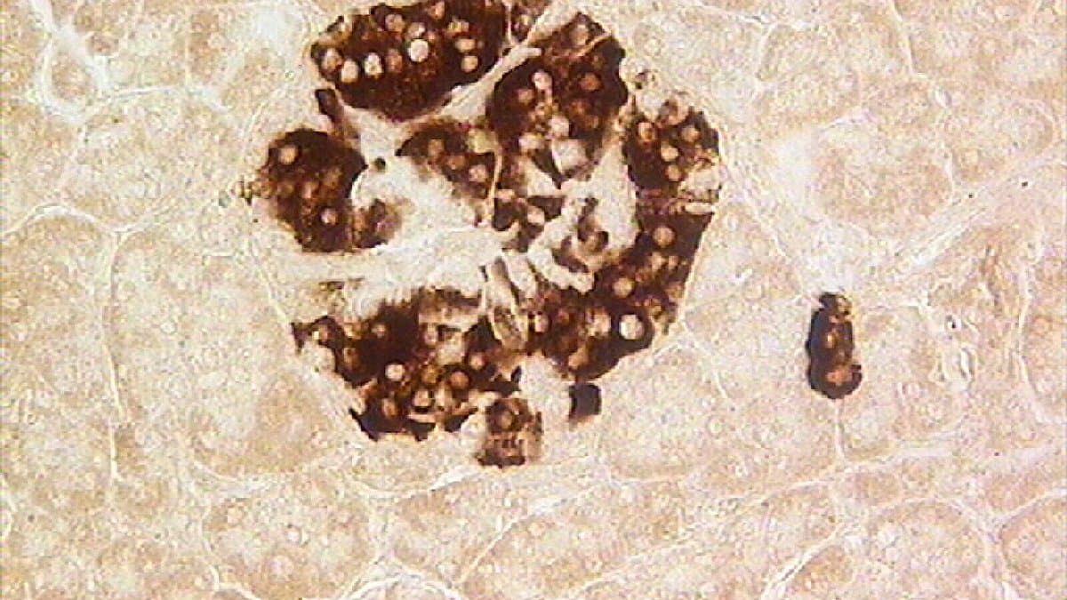 Photomicrograph of a pancreatic islet in which the insulin-producing beta cells are stained dark brown, surrounded by paler pancreatic tissue.
