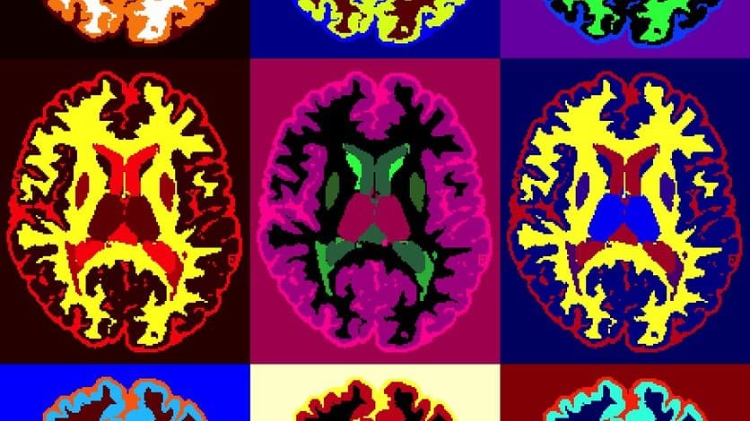 A three-by-three grid of axial MRI brain slices from a person with multiple sclerosis, each slice rendered in a different set of bright false colours.