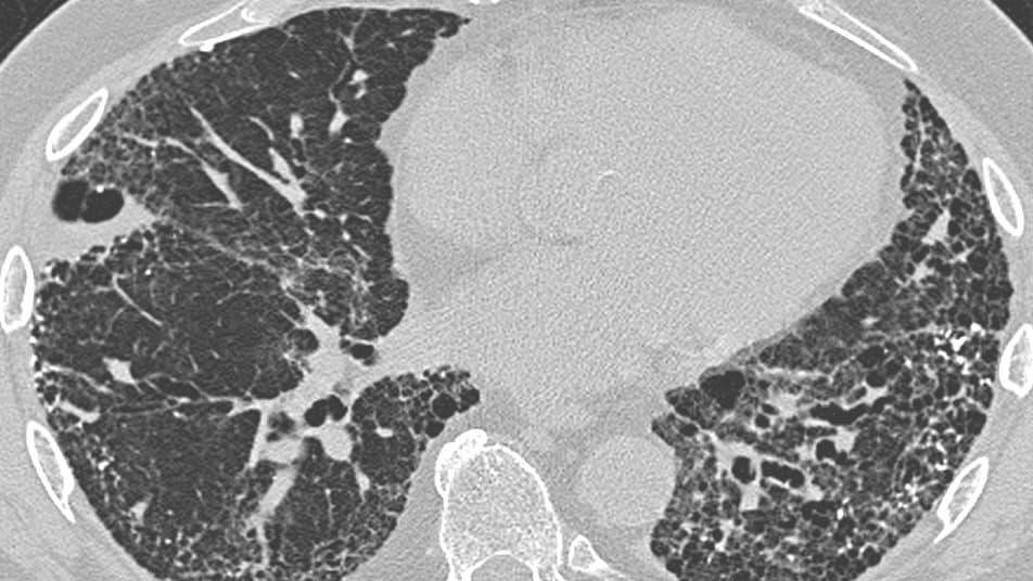 Axial chest CT slice showing both lungs filled with clustered cystic air spaces and thickened tissue bands at the periphery, the honeycombing pattern of usual interstitial pneumonia.