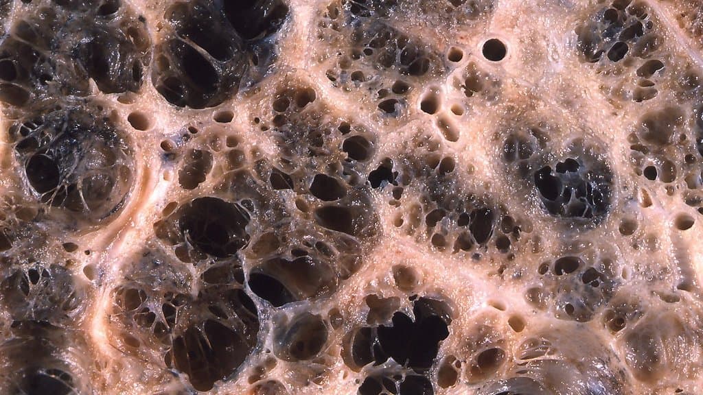 Close-up of a cut lung surface pitted with enlarged dark airspaces, the tissue destruction typical of centrilobular emphysema