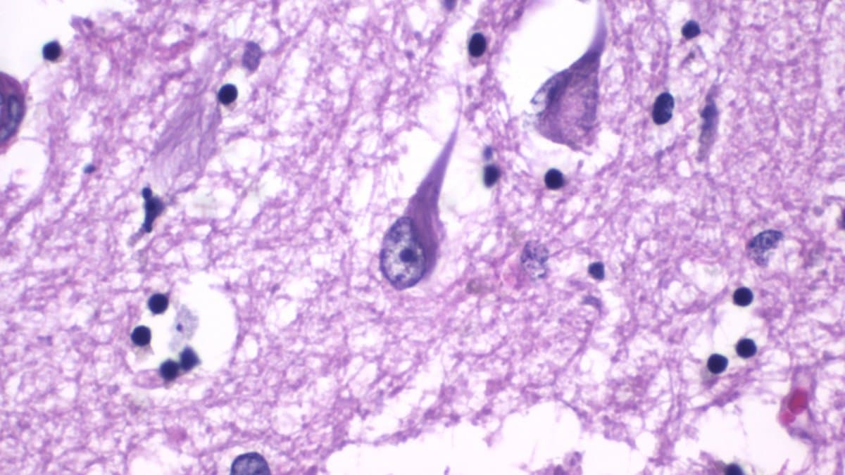 Microscope view of brain cortex tissue stained pink and purple, with several dark flame-shaped neurons carrying neurofibrillary tangles.
