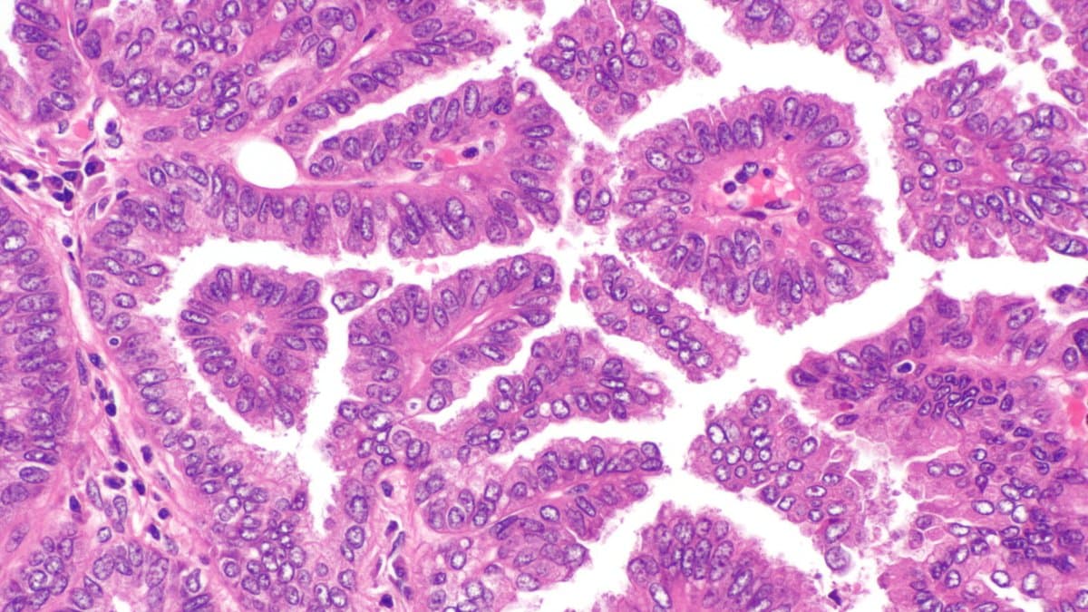 Photomicrograph of lung adenocarcinoma tissue stained pink and purple, with crowded tumor cells forming branching fronds.