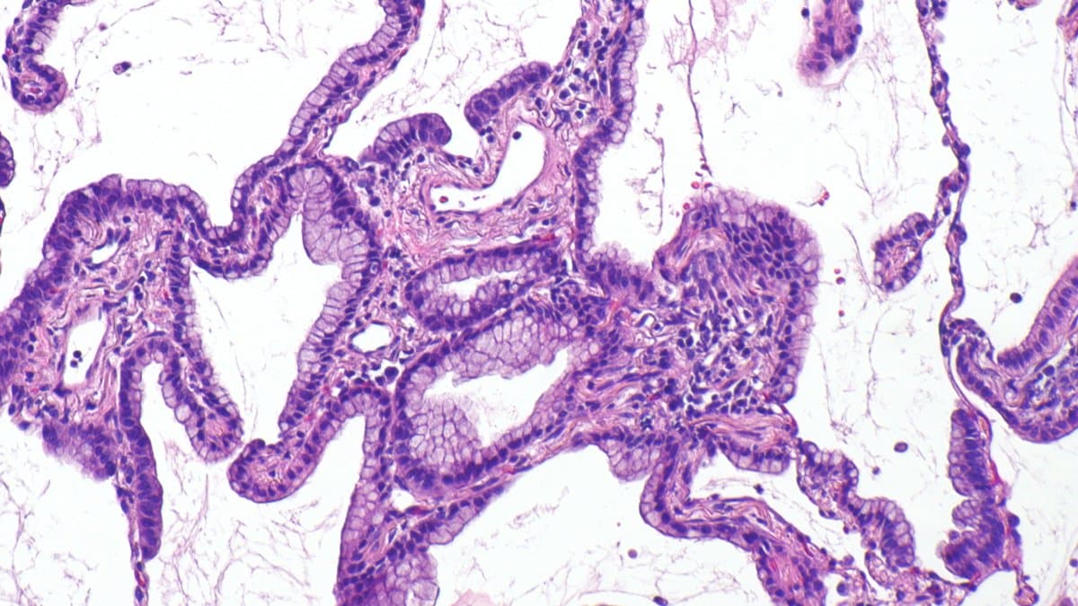 Photomicrograph of a lung adenocarcinoma: ribbons of purple-stained tumor cells lining irregular airspaces in pale pink lung tissue.