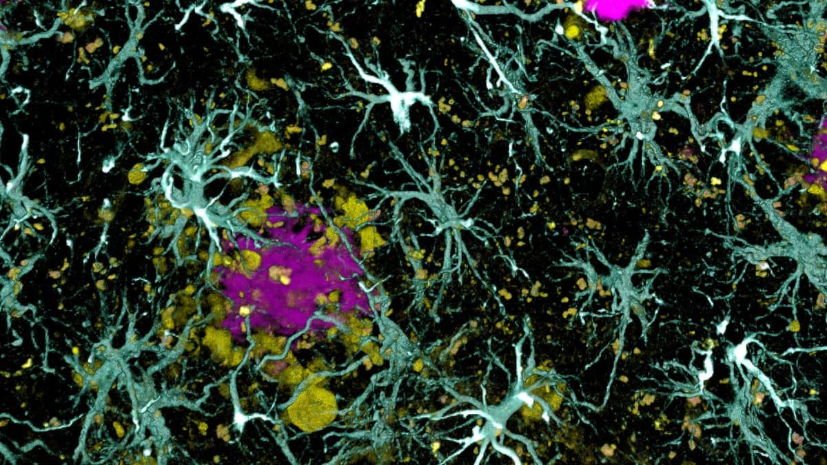 Confocal microscope image of brain tissue in which pale cyan star-shaped astrocytes cluster around a magenta amyloid plaque, with yellow deposits scattered around them.