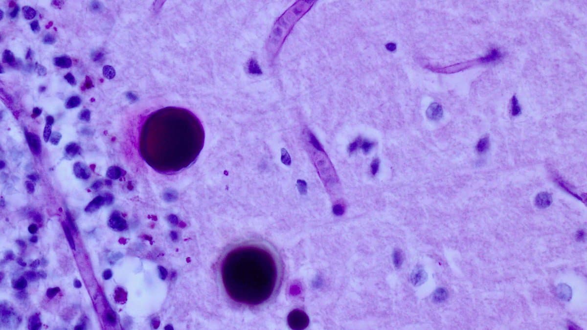 Microscope image of brain tissue showing two large dark round polyglucosan bodies among pale pink nerve tissue and scattered cell nuclei.