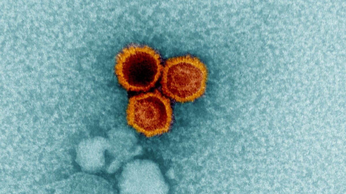 Colorized transmission electron micrograph of three round Epstein-Barr virus particles, orange against a pale teal background