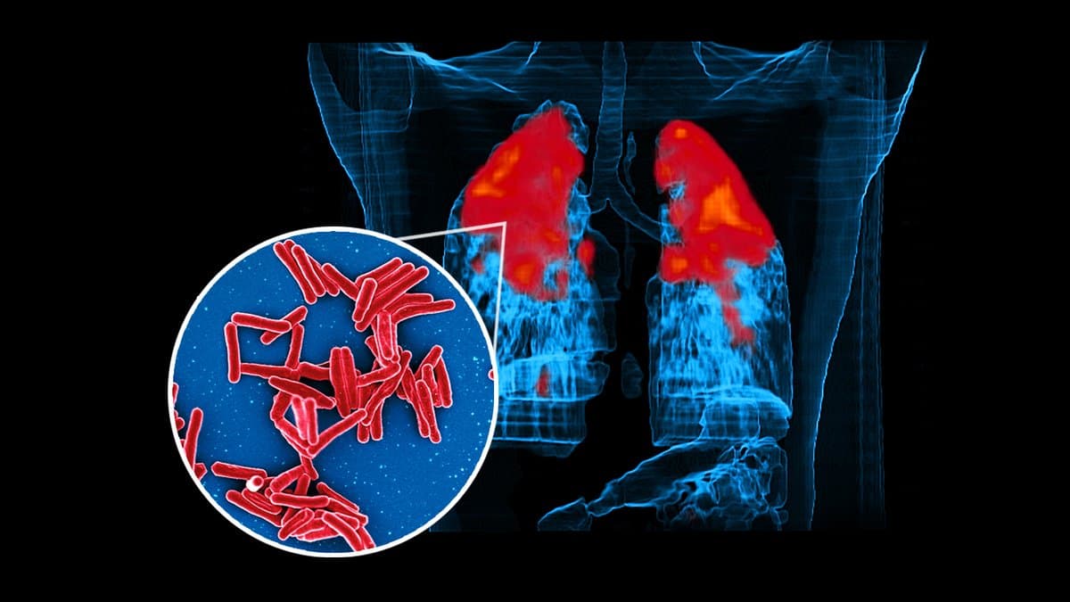 A three-dimensional CT reconstruction of a human chest showing tuberculosis disease in both lungs in red, with a circular inset of red rod-shaped Mycobacterium tuberculosis bacteria.