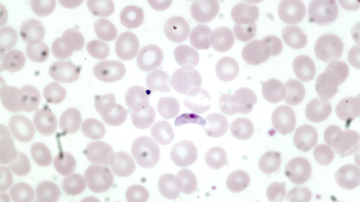 Light micrograph of a stained blood film in which one crescent-shaped Plasmodium falciparum gametocyte lies among round red blood cells.