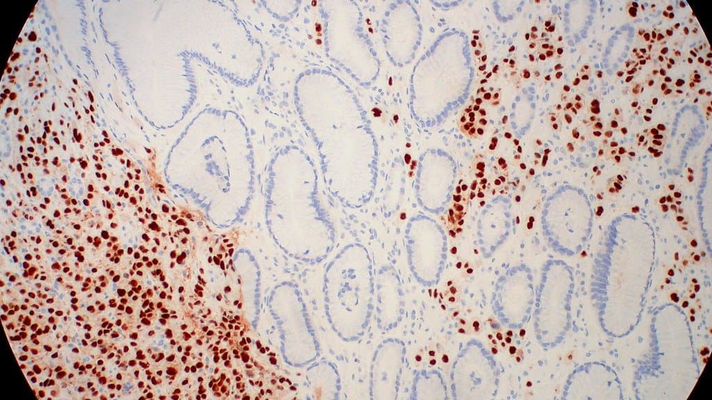 Photomicrograph of breast cancer that has spread to the stomach lining, stained for the estrogen receptor, with tumor cell nuclei dark brown against pale stomach glands.
