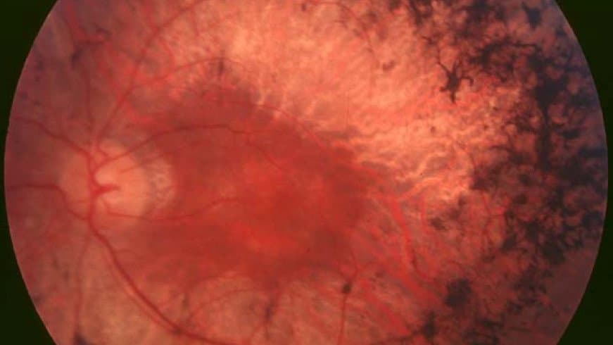 Color photograph of the inside of an eye, showing the pale optic disc, red blood vessels and dark spidery clumps of pigment spreading across the retina.