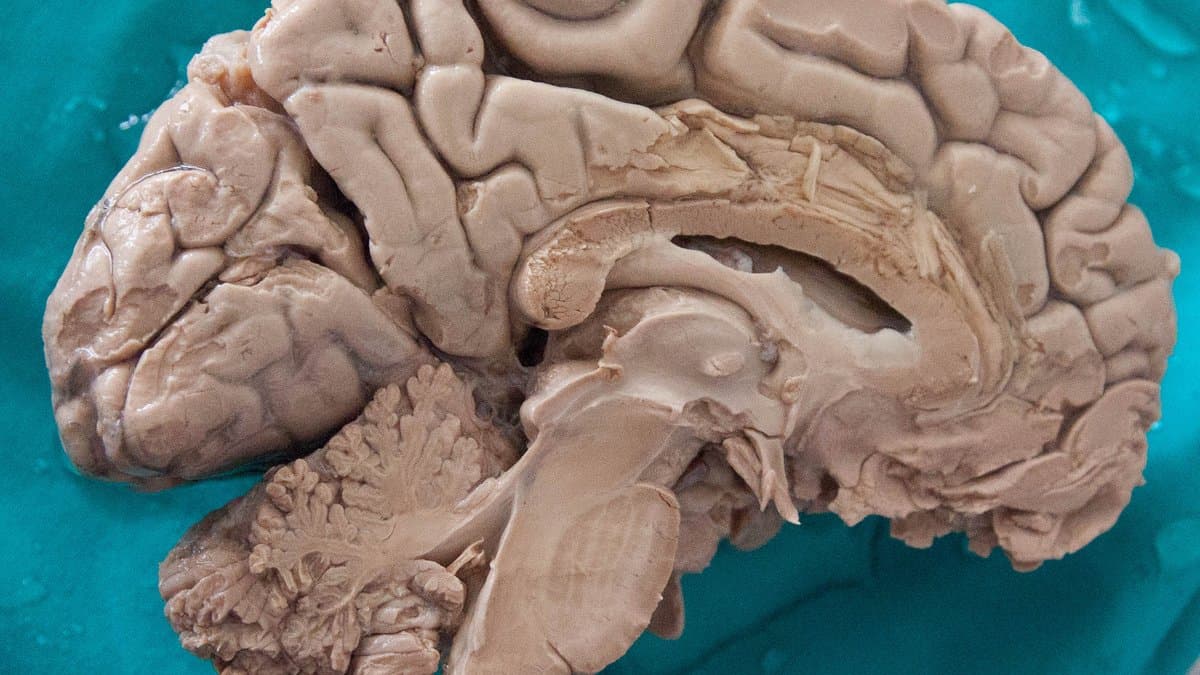 A dissected human brain seen from the midline, showing the folded cerebral cortex, the corpus callosum and the brainstem.