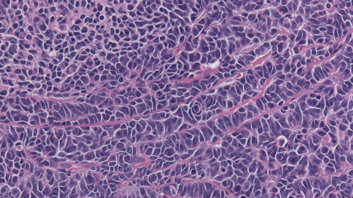 Photomicrograph of medulloblastoma tissue showing sheets of densely packed small tumor cells with dark nuclei, stained purple and pink.