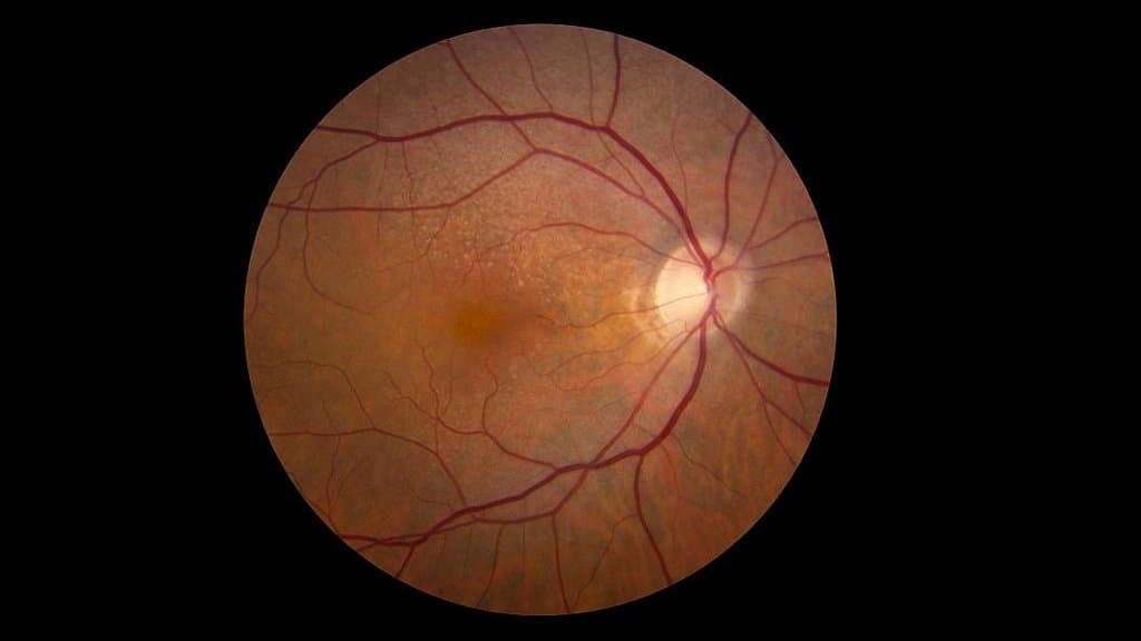 Color fundus photograph of the back of a human eye: an orange-red retina with branching blood vessels and a bright optic disc, ringed by black.