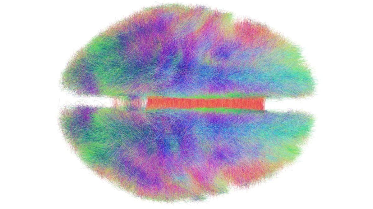 Whole-brain tractography render seen from above, with bundles of nerve fibers in green, blue, pink and purple filling both hemispheres and a red band of fibers crossing the midline.