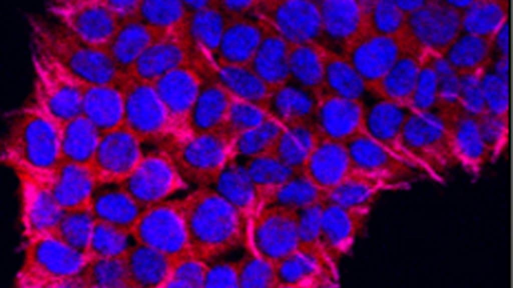 Fluorescence micrograph of a cluster of pancreatic cancer cells, nuclei stained blue and a cytoplasmic marker in magenta against a black background.