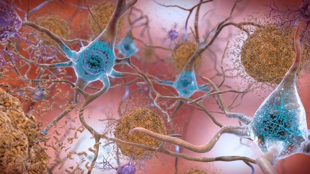 Illustration of neurons in the brain with amyloid-beta plaques and tau tangles characteristic of Alzheimer's disease
