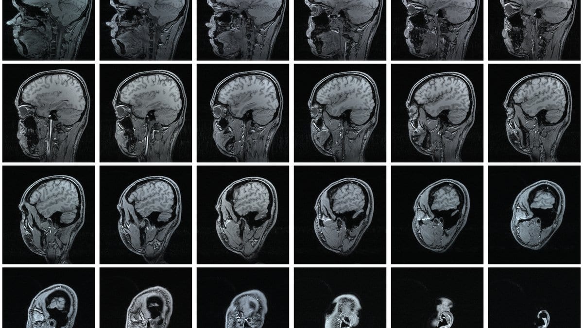 A grid of sagittal magnetic resonance imaging slices through a single human head, showing the brain in greyscale cross-section.