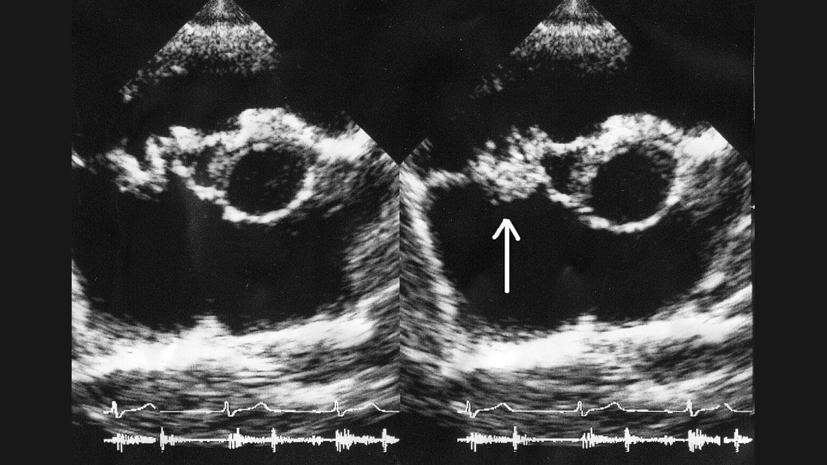 Two side-by-side greyscale echocardiogram frames of a heart, with an arrow in the right-hand frame pointing to an abnormal mass on a valve, and ECG traces running along the bottom of each frame.