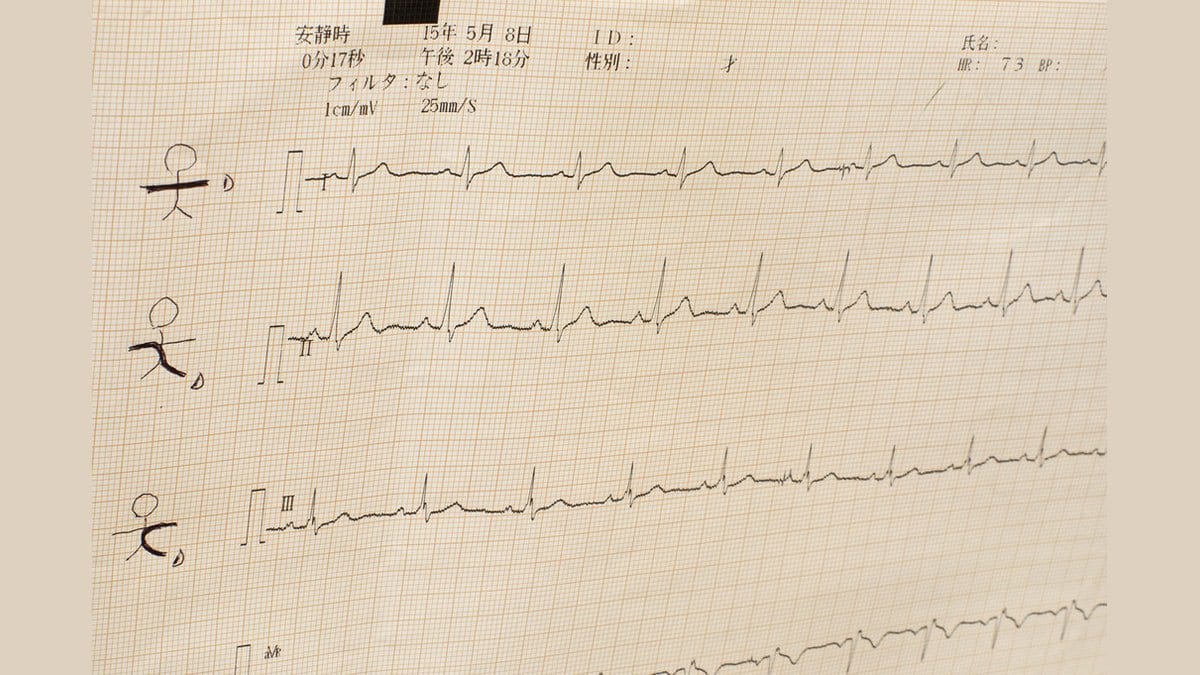 A close-up photograph of a paper electrocardiogram printout, showing several rows of heartbeat traces inked on graph paper above a printed header of recording settings.