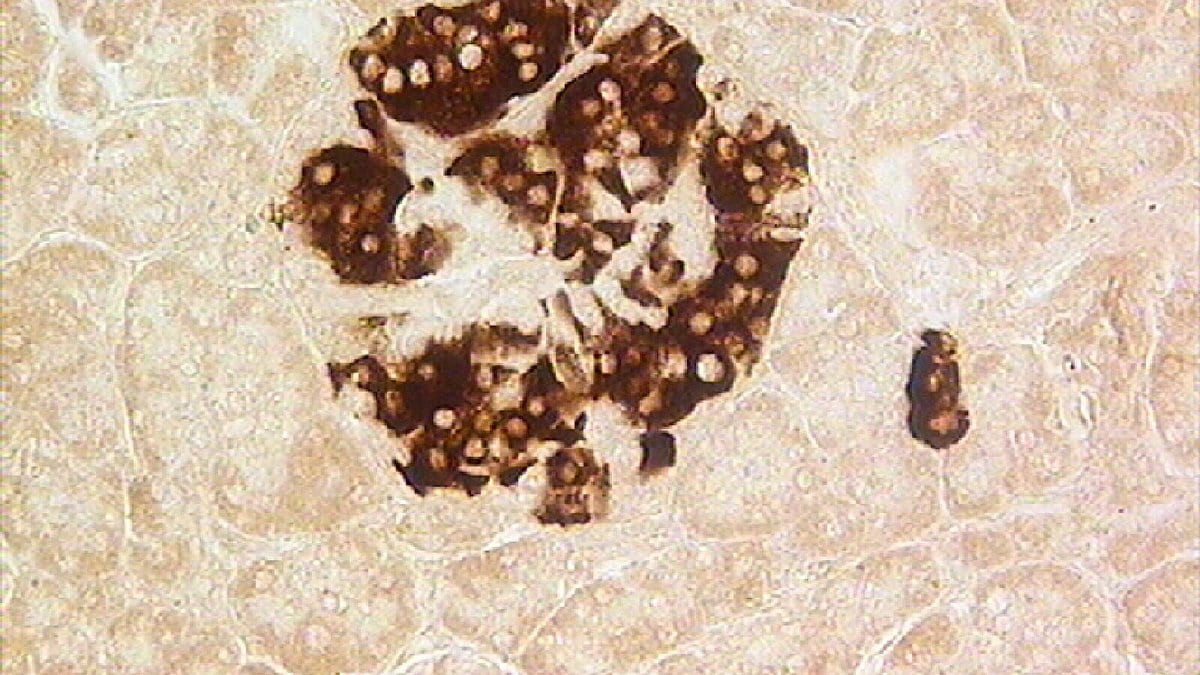 Photomicrograph of a pancreatic islet in which the insulin-producing beta cells are stained dark brown, surrounded by paler pancreatic tissue.