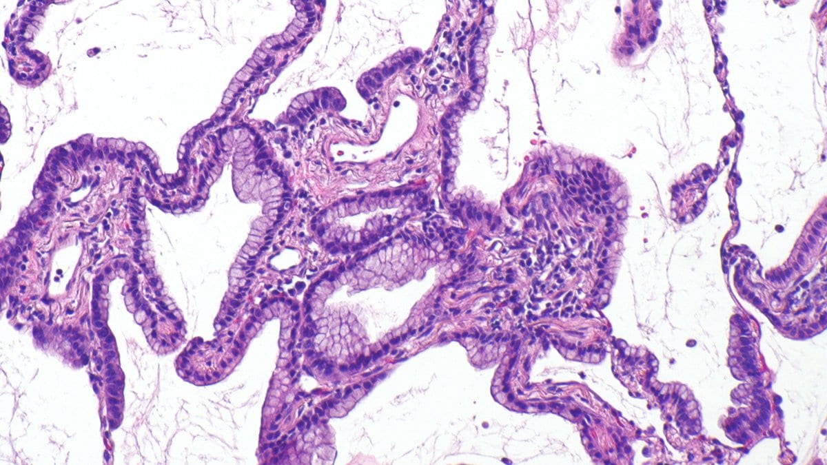 Photomicrograph of a lung adenocarcinoma: ribbons of purple-stained tumor cells lining irregular airspaces in pale pink lung tissue.
