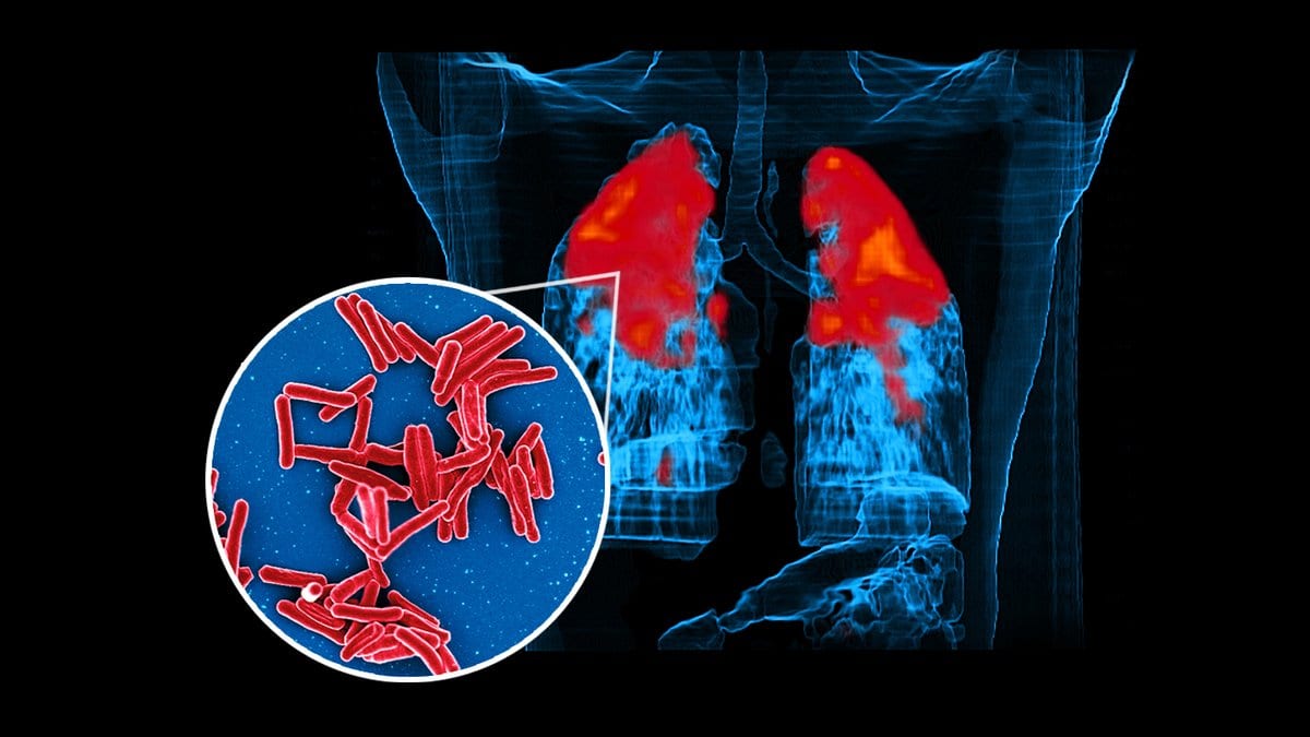 A three-dimensional CT reconstruction of a human chest showing tuberculosis disease in both lungs in red, with a circular inset of red rod-shaped Mycobacterium tuberculosis bacteria.