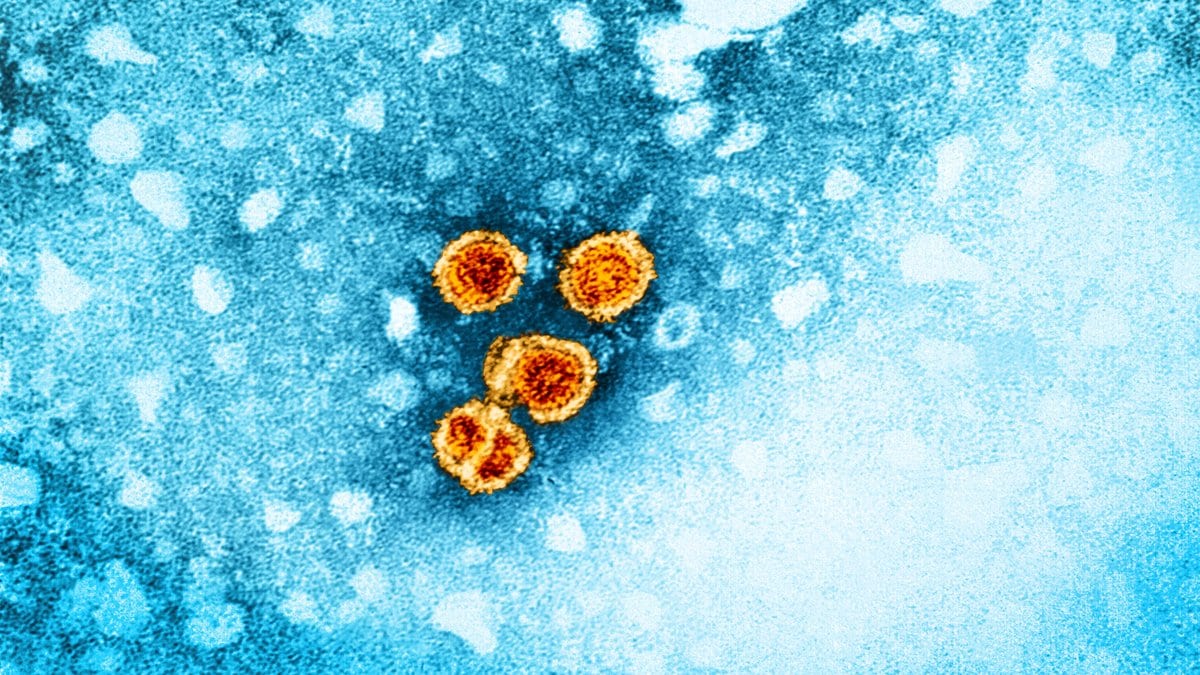 Colorized transmission electron micrograph showing four round orange hepatitis B virus particles against a blue cellular background.