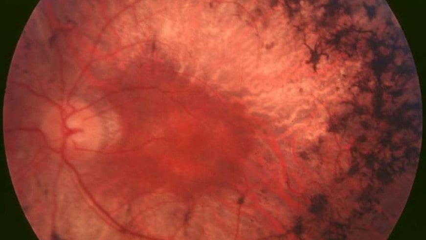 Color photograph of the inside of an eye, showing the pale optic disc, red blood vessels and dark spidery clumps of pigment spreading across the retina.