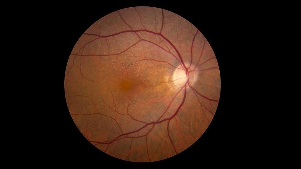 Color fundus photograph of the back of a human eye: an orange-red retina with branching blood vessels and a bright optic disc, ringed by black.