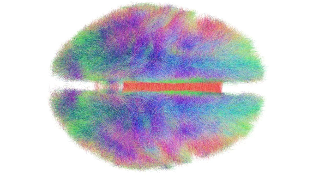 Whole-brain tractography render seen from above, with bundles of nerve fibers in green, blue, pink and purple filling both hemispheres and a red band of fibers crossing the midline.