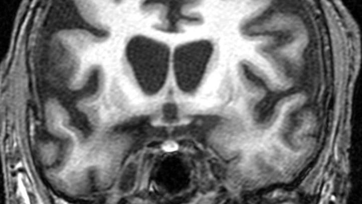 Coronal MRI of a human head showing widened lateral ventricles and shrunken caudate nuclei typical of Huntington's disease.