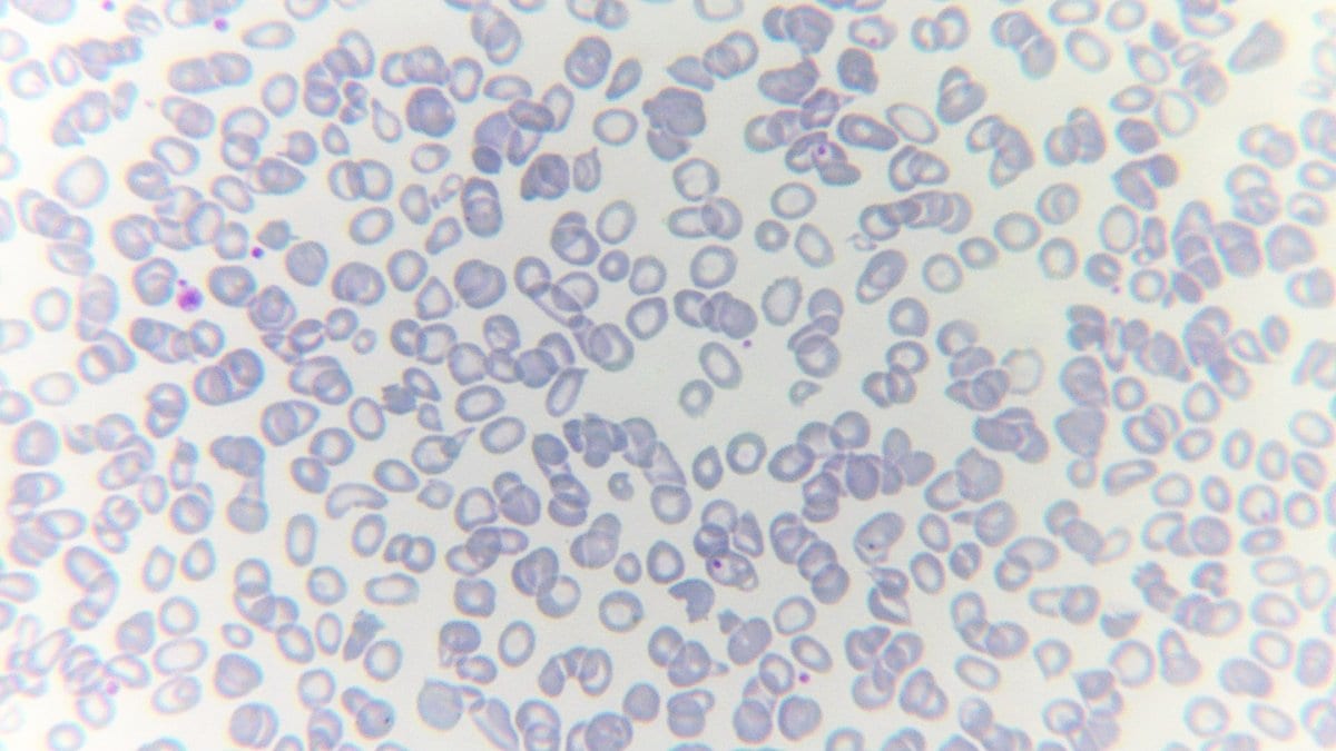 Light micrograph of a blood smear in which the red blood cells look pale, thin and uneven in shape.